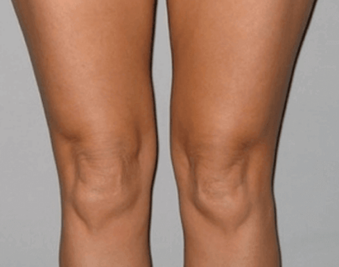 I cured knee osteoarthritis with Artovitel gel