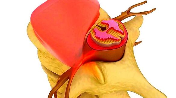 osteochondrosis of the thoracic spine The essence of the disease