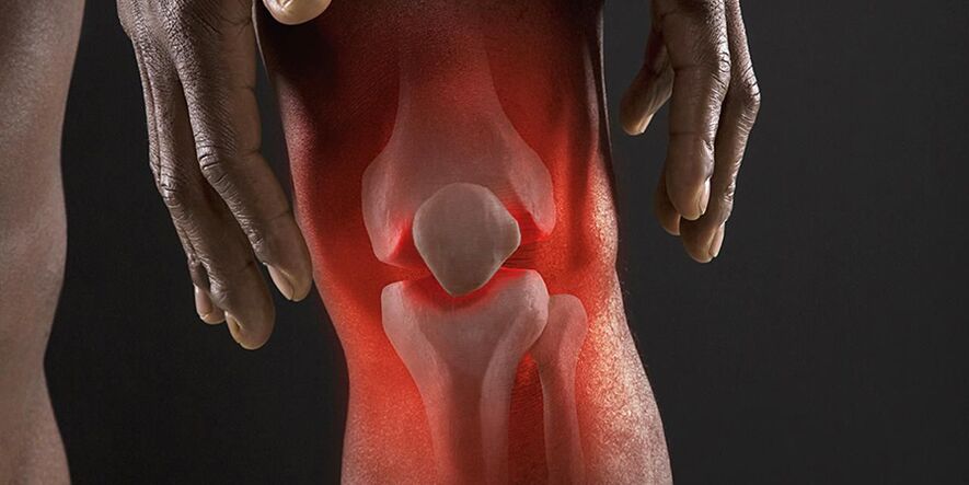 A burning sensation in the knee is a symptom of knee osteoarthritis